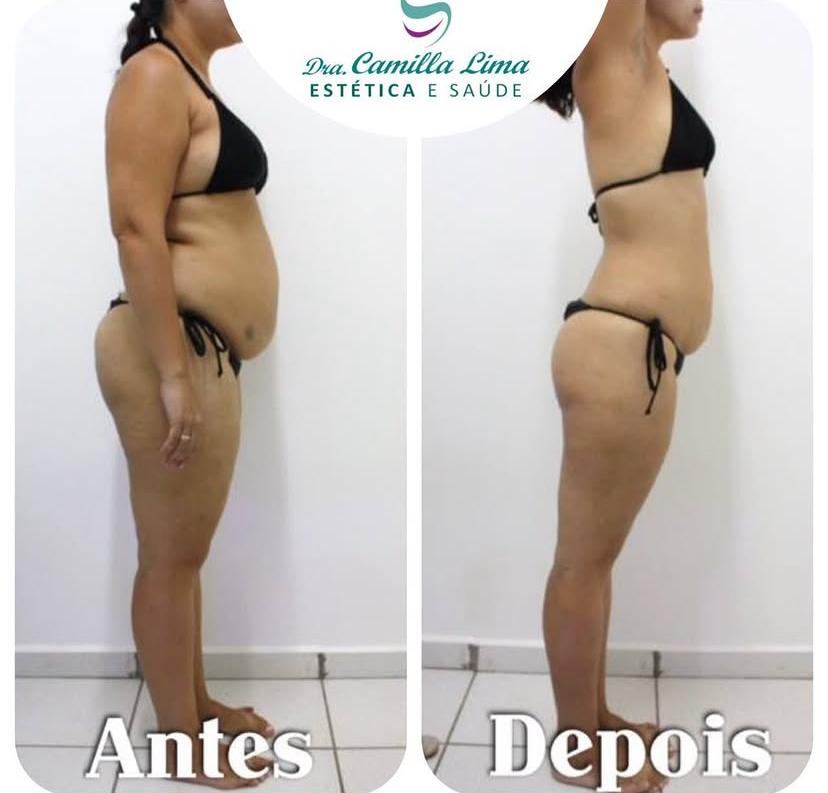 Resultado antes e depois 1
