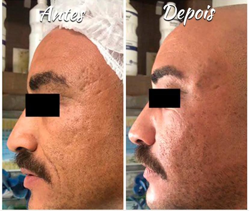 Resultado antes e depois 3