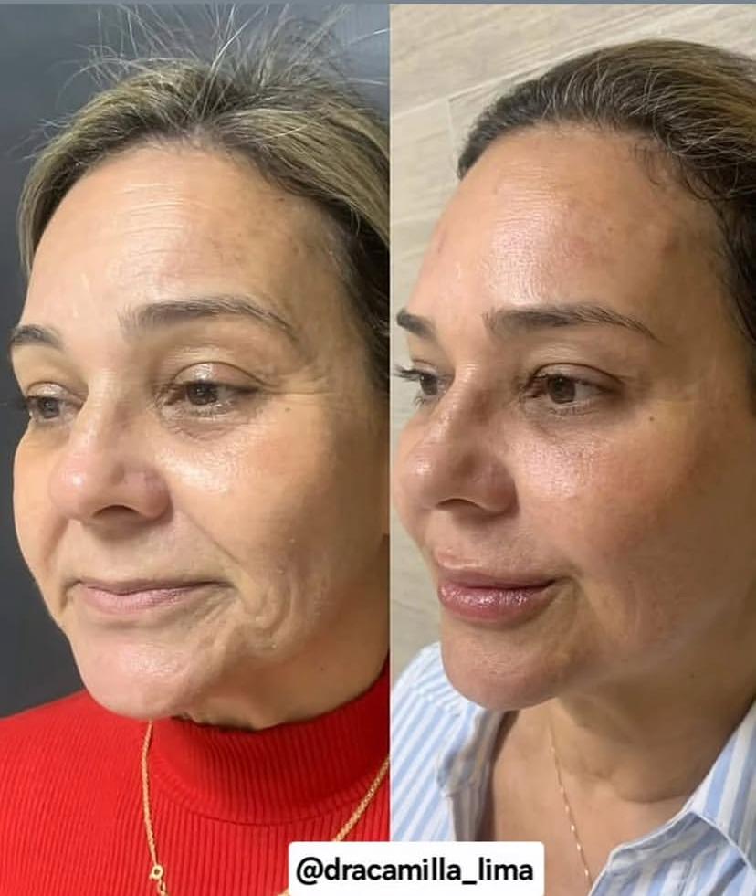Resultado antes e depois 5