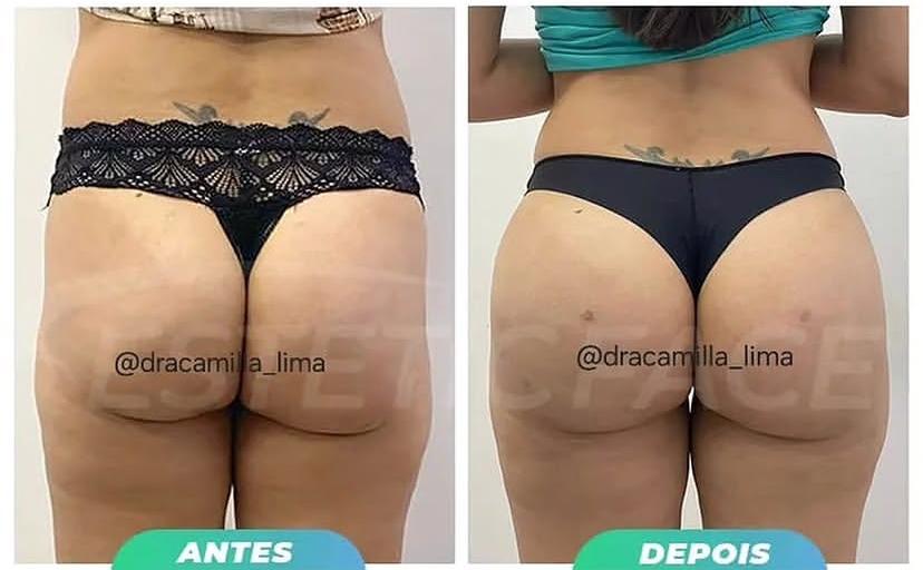Resultado antes e depois 6