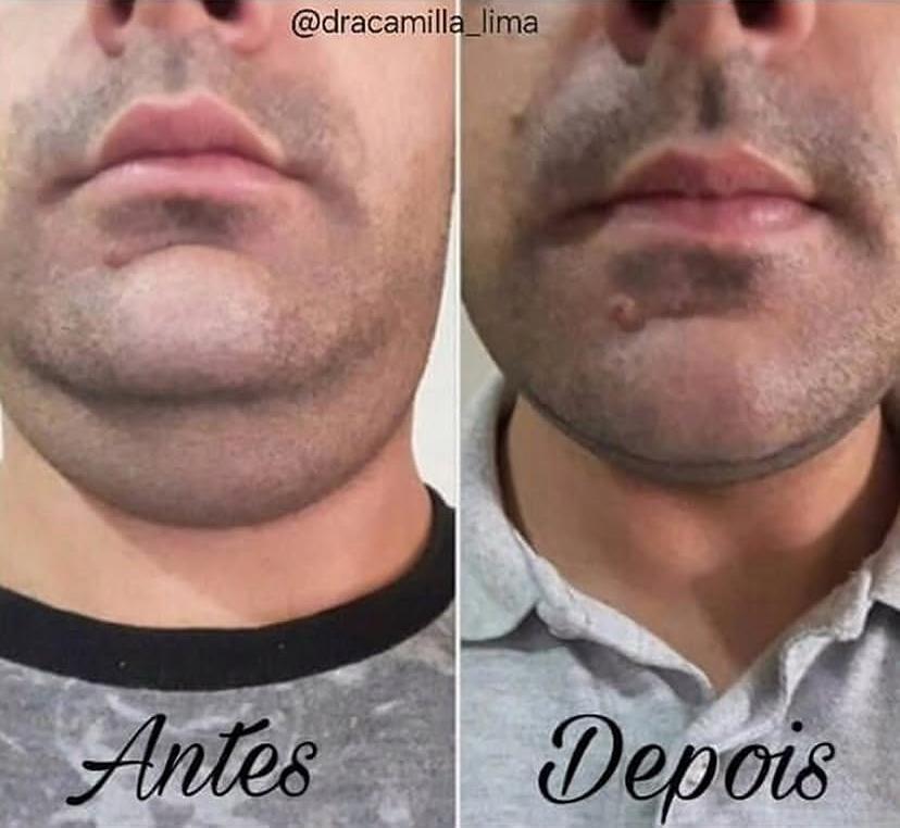 Resultado antes e depois 8
